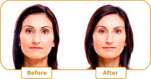 Photo of All You Need To Learn About Juvederm Montreal